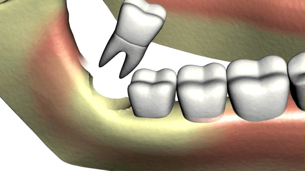 Wisdom tooth extraction Implantcenter dentistry UK